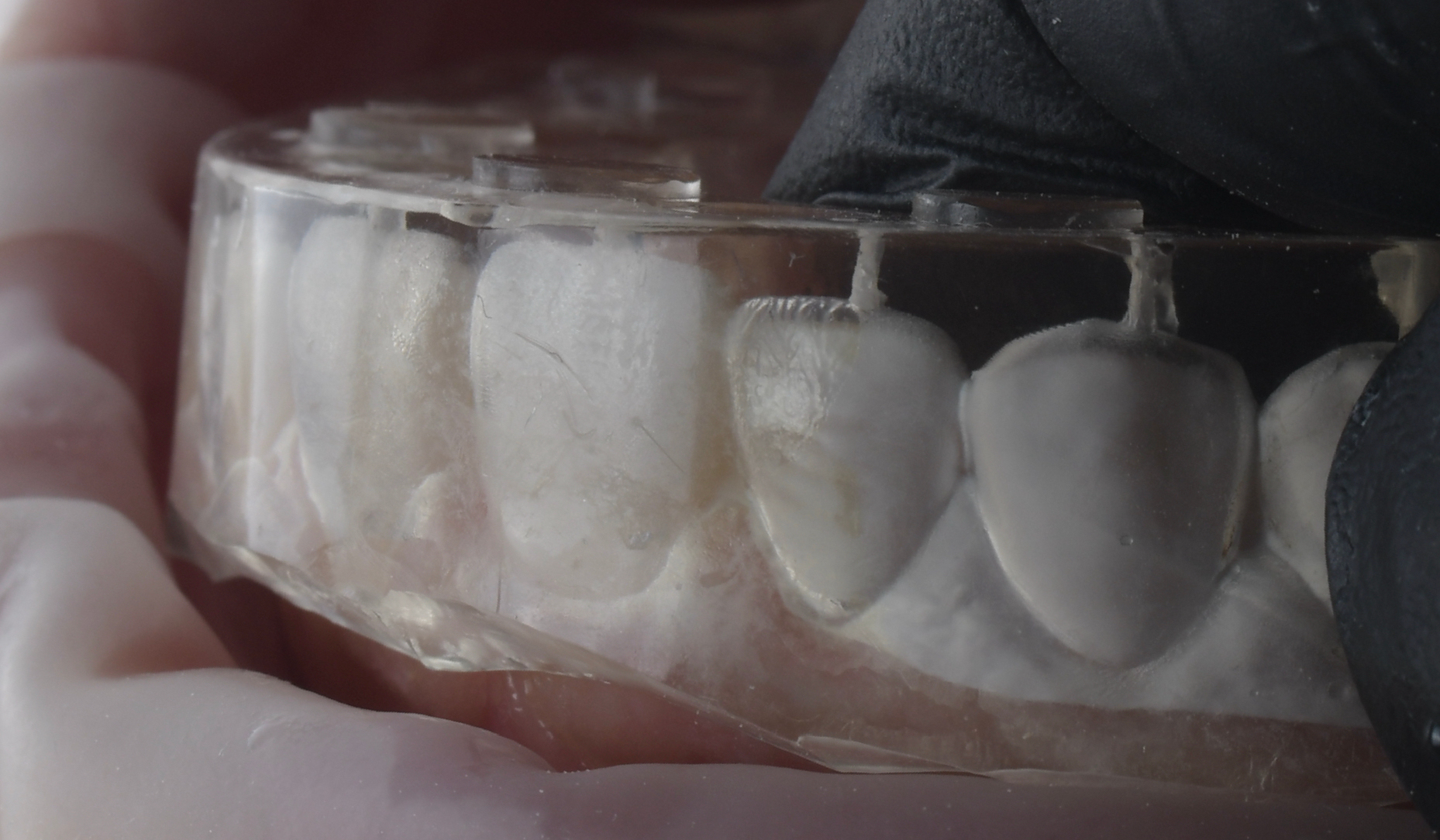 Figure 11: Silicone index placed over the teeth including the tooth with the defect.